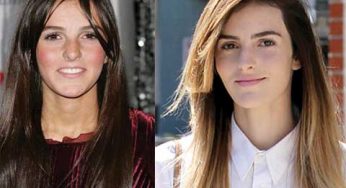 Ali Lohan Plastic Surgery