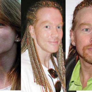 Axl Rose Plastic Surgery