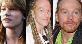 Axl Rose Plastic Surgery