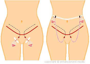 before and after tummy tuck surgery photos 2022