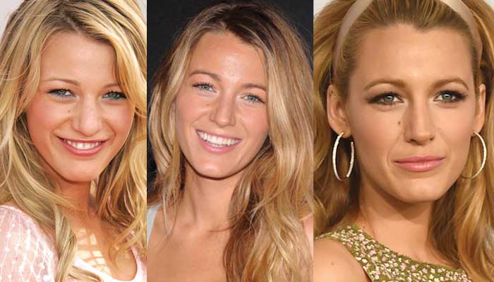 blake lively plastic surgery before and after photos 2022