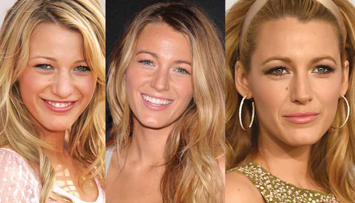 blake lively plastic surgery before and after photos