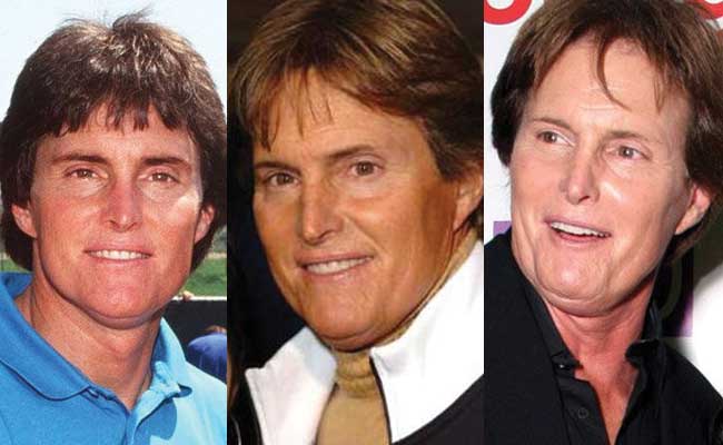 Bruce Jenner Plastic Surgery Before And After Pictures 2024