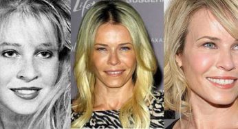 Chelsea Handler Plastic Surgery