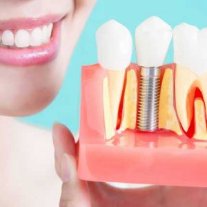 Dental Implant Cost in USA