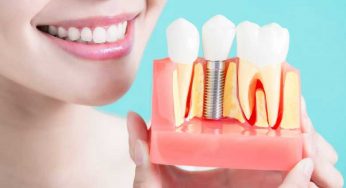 Dental Implant Cost in USA