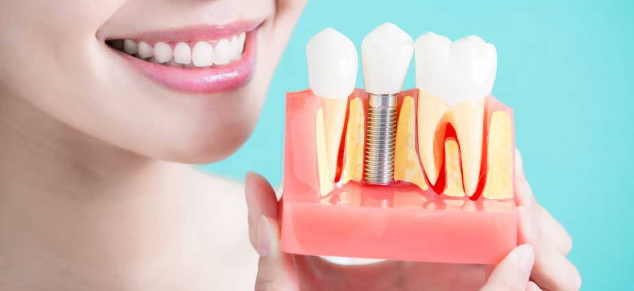 dental implant cost in usa