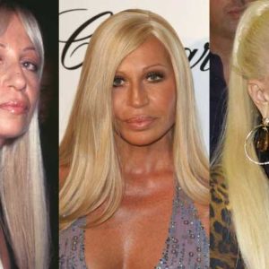 Donatella Versace Plastic Surgery