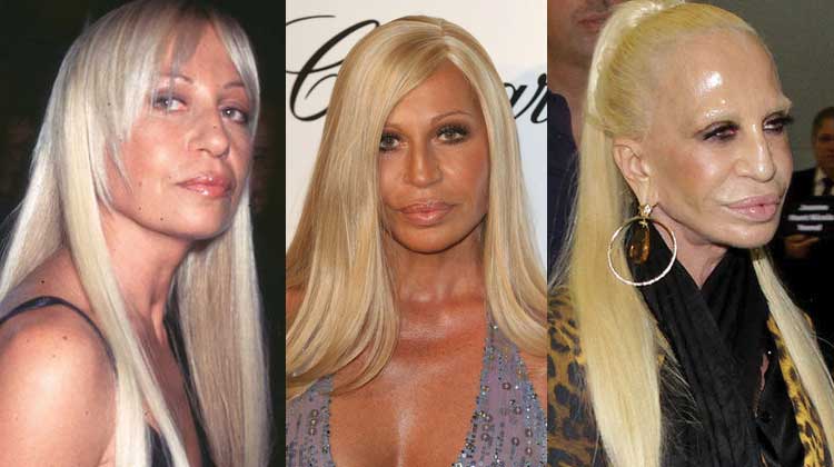 Donatella Versace Before and After Plastic Surgery - Vanity