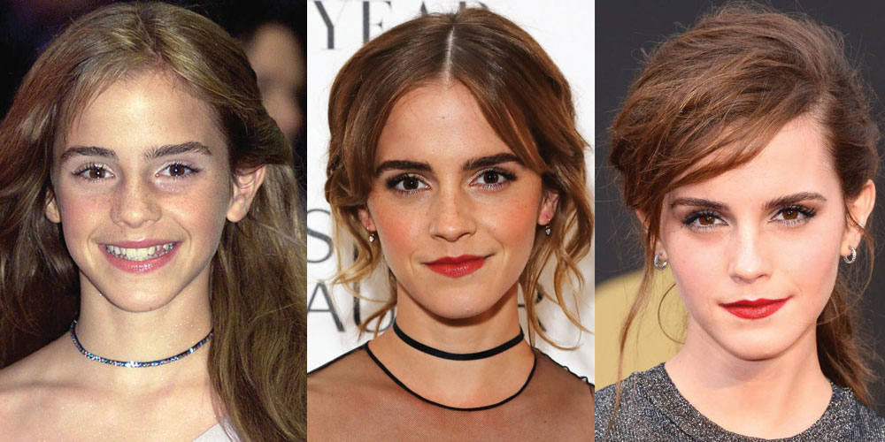 Emma Watson Plastic Surgery Before and After Pictures 2022.