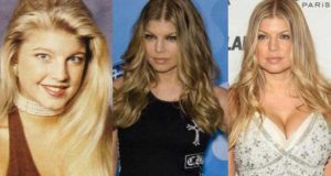 fergie plastic surgery before and after photos
