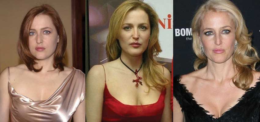 Gillian Anderson Plastic Surgery Before and After Pictures 2022.