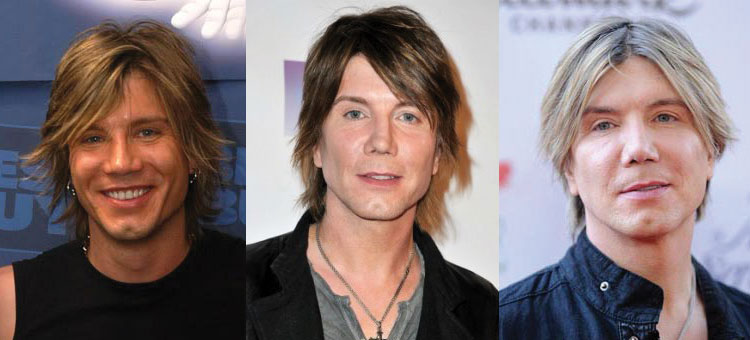 john rzeznik plastic surgery before and after