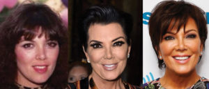 Kris Jenner Plastic Surgery Before and After Pictures 2025