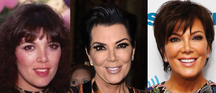kris jenner before and after plastic surgery 2022