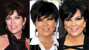 kris jenner plastic surgery before and after