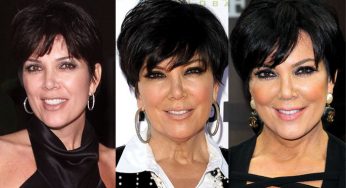 Kris Jenner Plastic Surgery