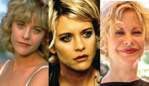 meg ryan plastic surgery before and after photos