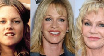 Melanie Griffith Plastic Surgery