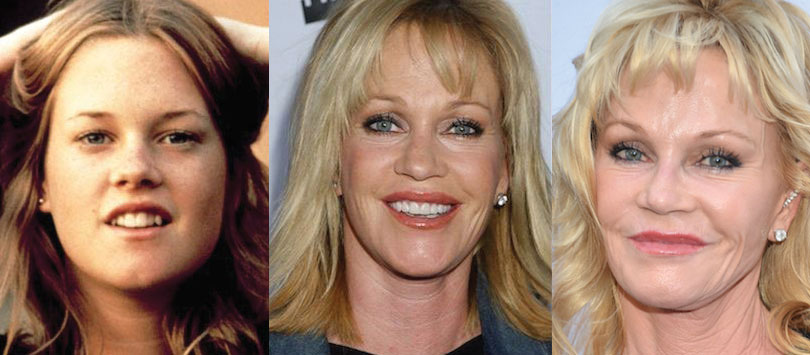 melanie griffith plastic surgery before and after 2022