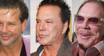 Mickey Rourke Plastic Surgery