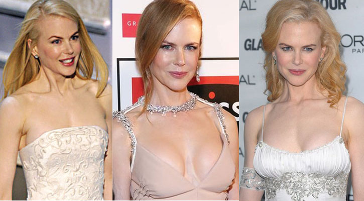 nichole kidman before and after plastic surgery 2023