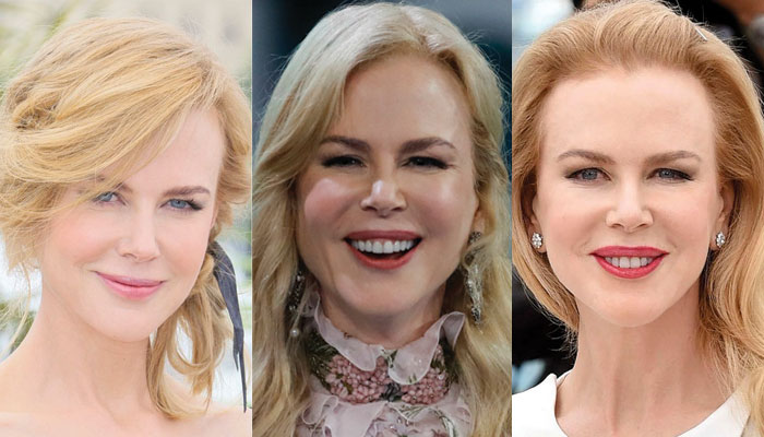 nichole kidman plastic surgery before and after