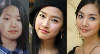 Park Min Young Plastic Surgery