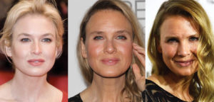 renee zellweger plastic surgery before and after