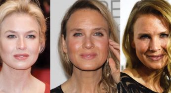 Renee Zellweger Plastic Surgery
