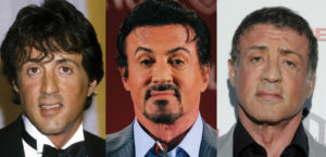 sylvester stallone plastic surgery before and after
