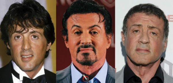 Sylvester Stallone Plastic Surgery Before and After Pictures 2025