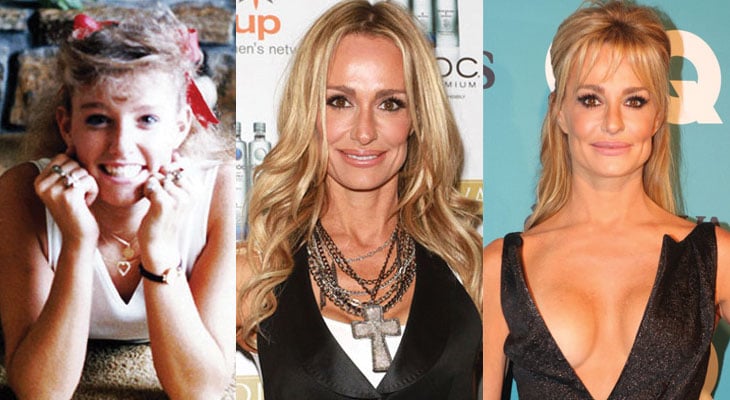 taylor armstrong before and after plastic surgery 2024