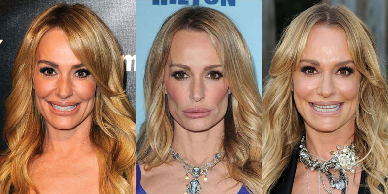 taylor armstrong plastic surgery before and after