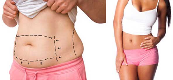 tummy tuck surgery before and after pictures 2024